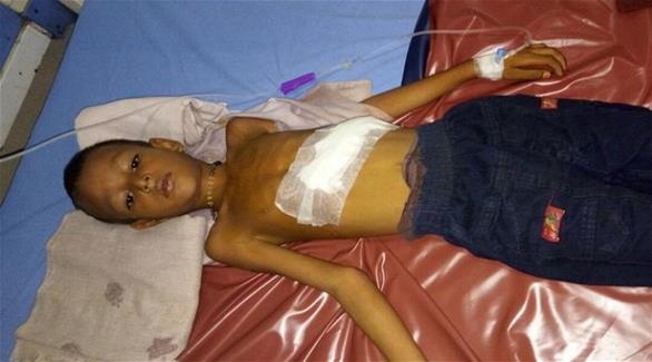 أطباء يكتشفون جنيناً غير مكتمل داخل بطن طفل في السادسة بالهند (ميرور)