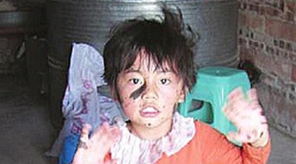 الطفلة الصينية المصابة مرض جلدي نادر زهاو كسينراو 